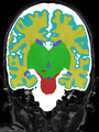 Xu.17.icip-coronal40Test5054Seg.png