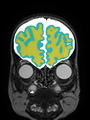 Xu.17.icip-coronal40Test5021Seg.png