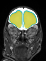 Xu.17.icip-coronal30Test509Seg.png